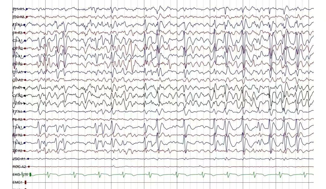异常脑电图尖波尖慢波图片