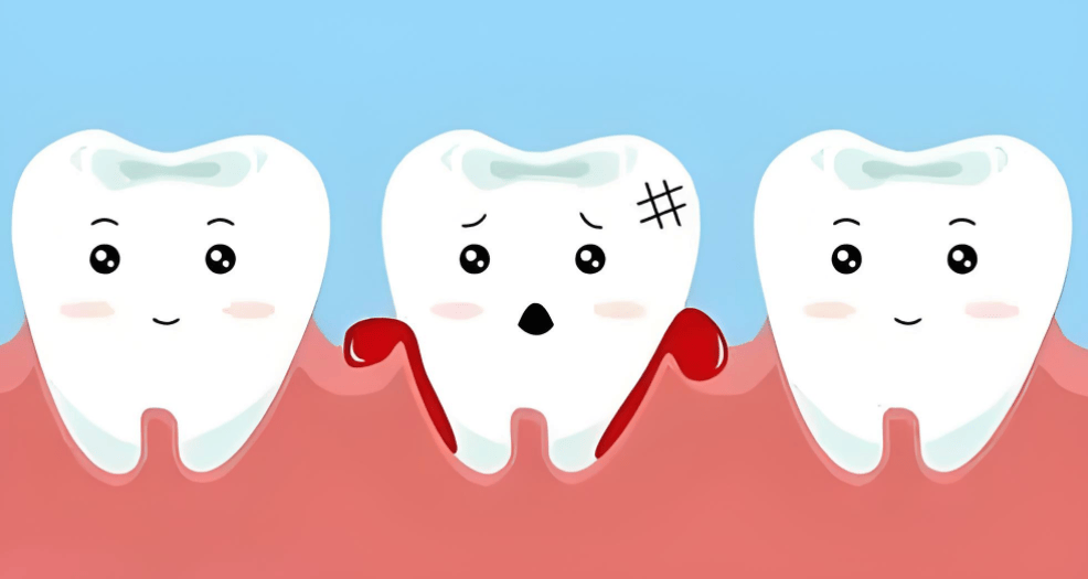 军营健康桥丨被忽视的牙龈出血(图2)