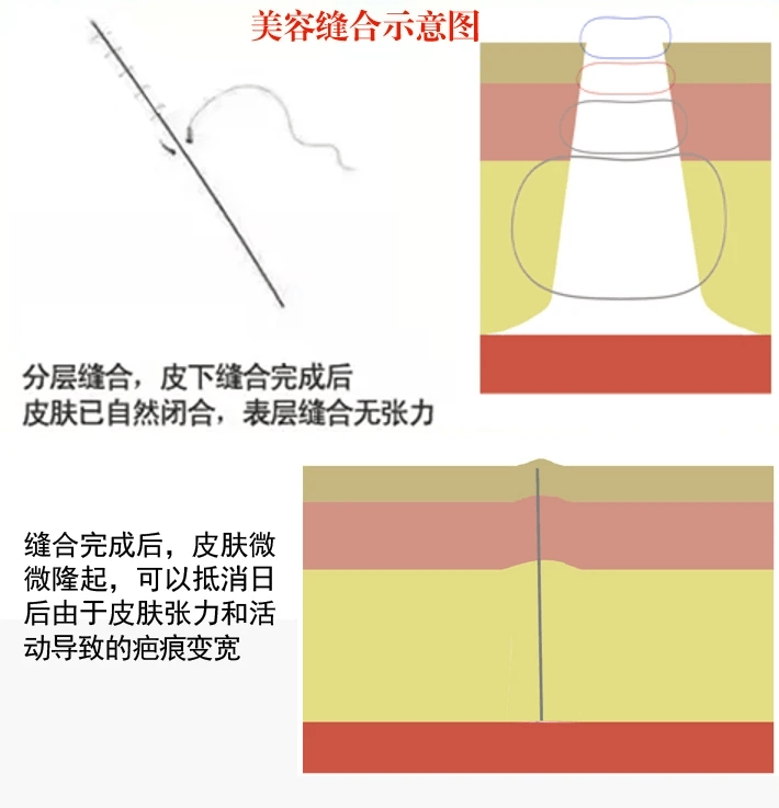 螺旋缝合方法图解图片