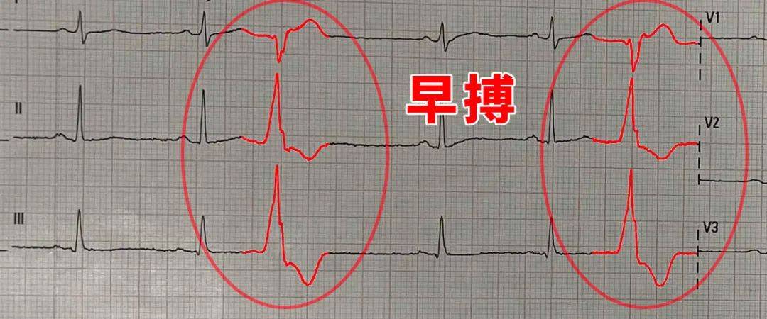 心脏早搏最佳治疗方法图片