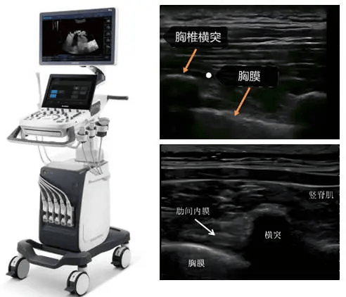 前锯肌神经阻滞超声图图片