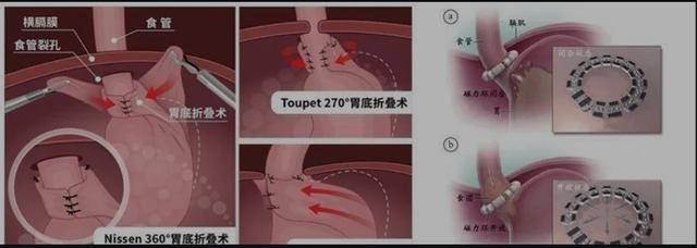 看潍坊市第二人民医院胃食管反流如何治疗(图2)