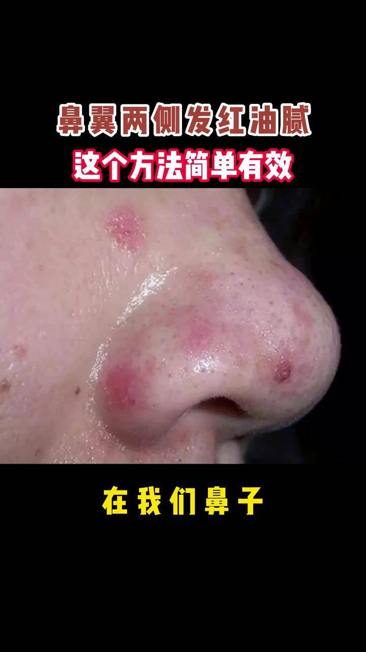 脂溢性皮炎皮肤科普护肤万粉扶持计划万粉成长计划我和我的患者朋友