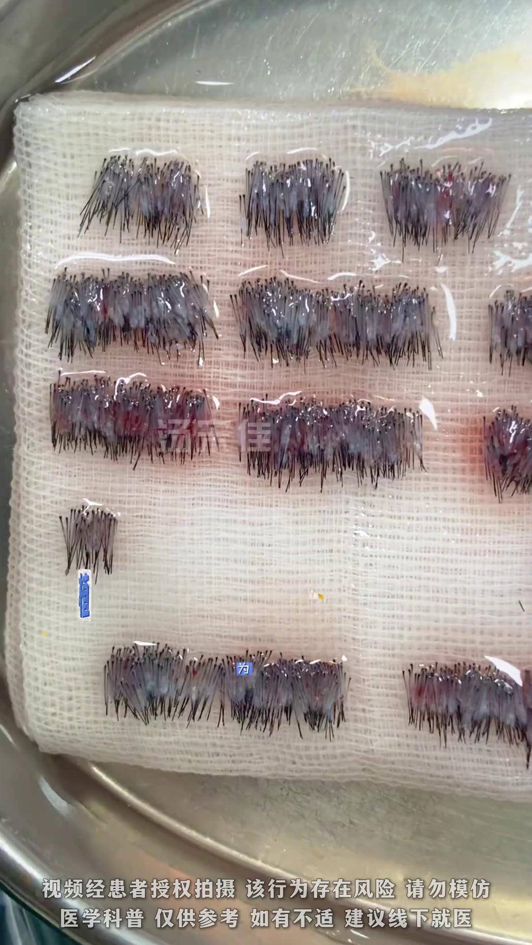 植发分离毛囊技术(植发手术毛囊从哪里提取)
