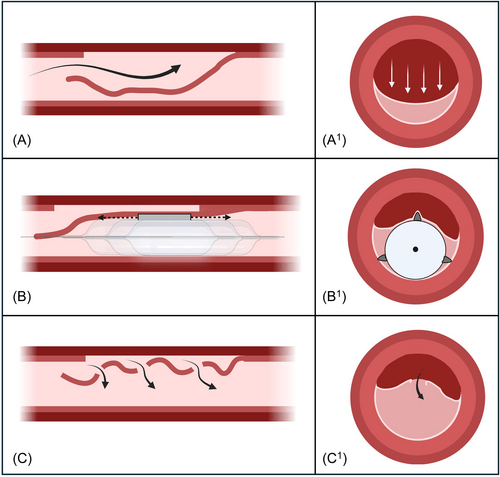 cuttering(哆切)技术切开夹层血肿