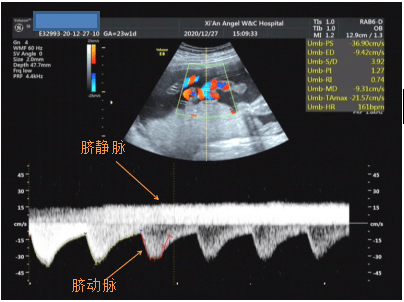 脐动脉和脐静脉只要有相对运动就有多普勒效应,比如输尿管向膀胱喷尿
