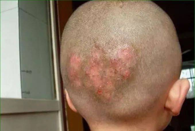 毛囊炎不简单,快来看看怎么辩证处理