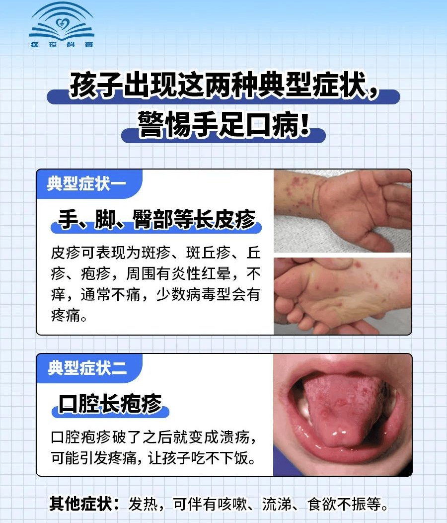 手足口病进入高发期!
