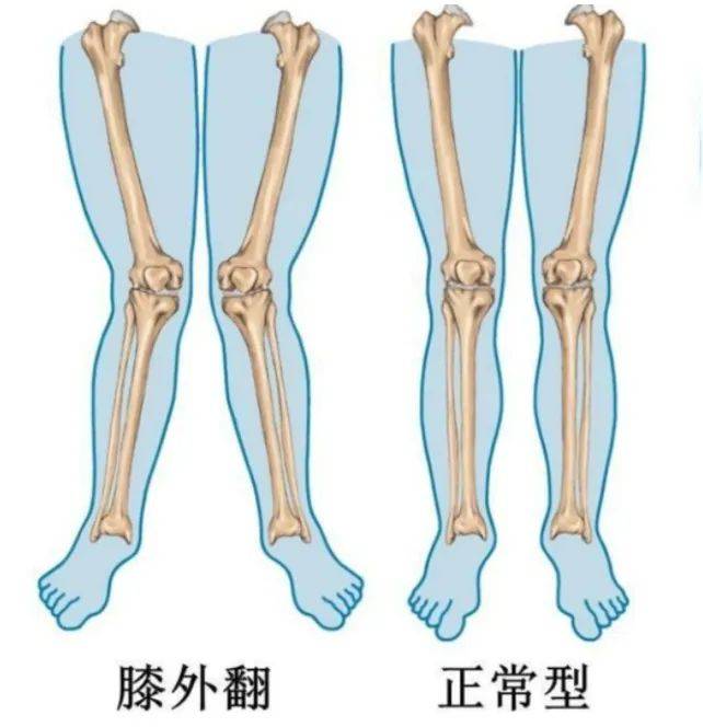 孩子腿膝盖往后弯图片