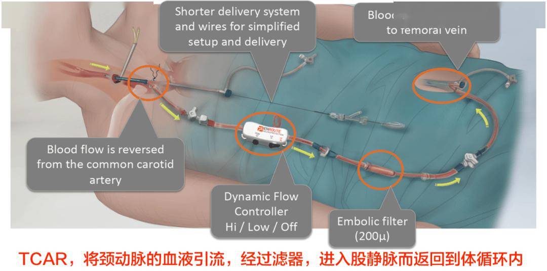 carotidartery图片