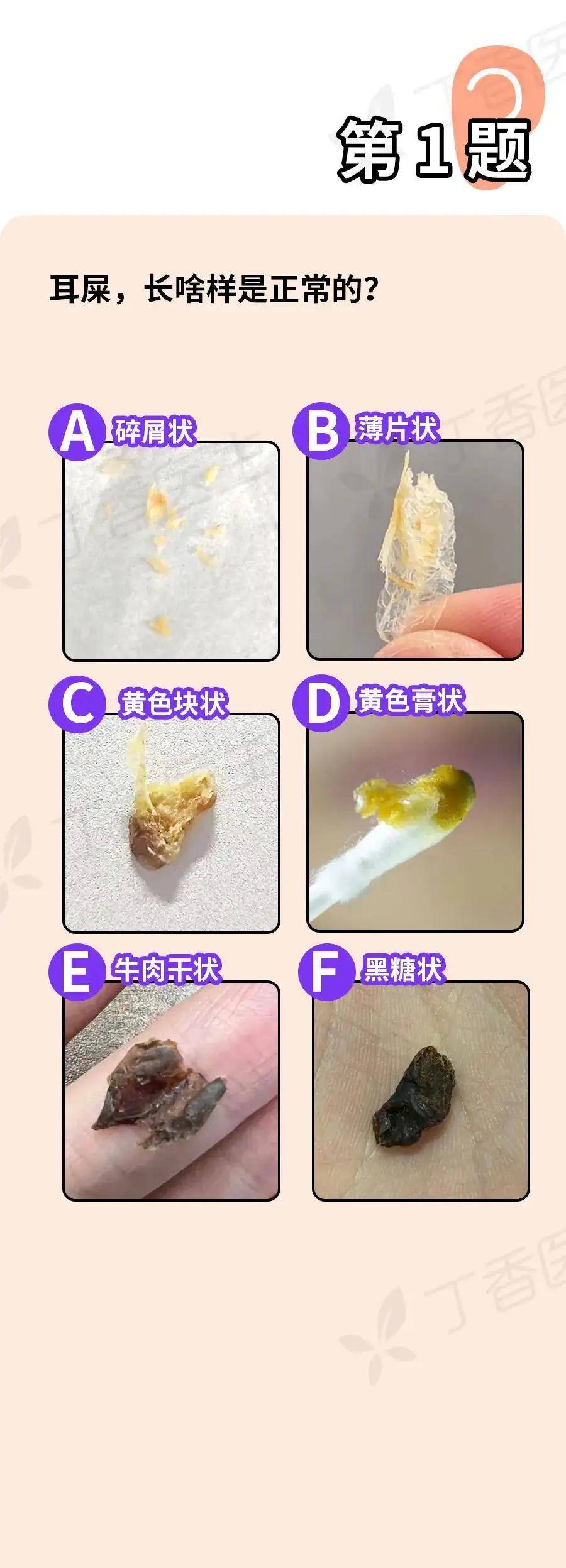 耳屎放大1000倍的图片图片