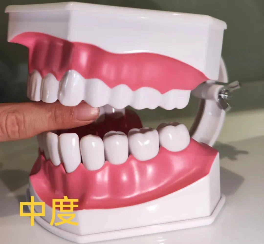 张口受限小科普_临床_关节_患者