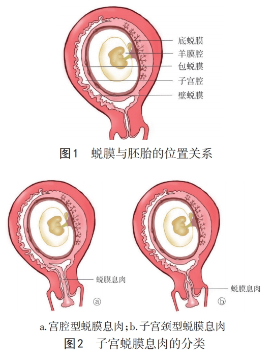 妊娠期子宫蜕膜息肉