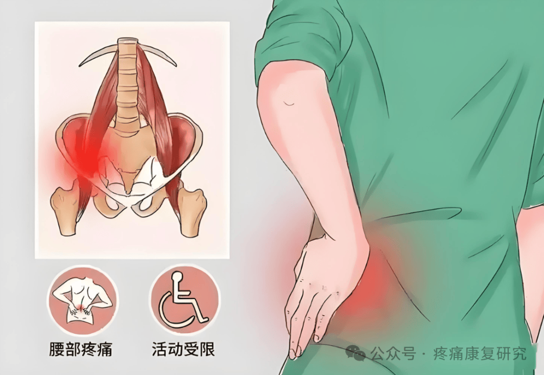 腰肌劳损疼的位置图片图片