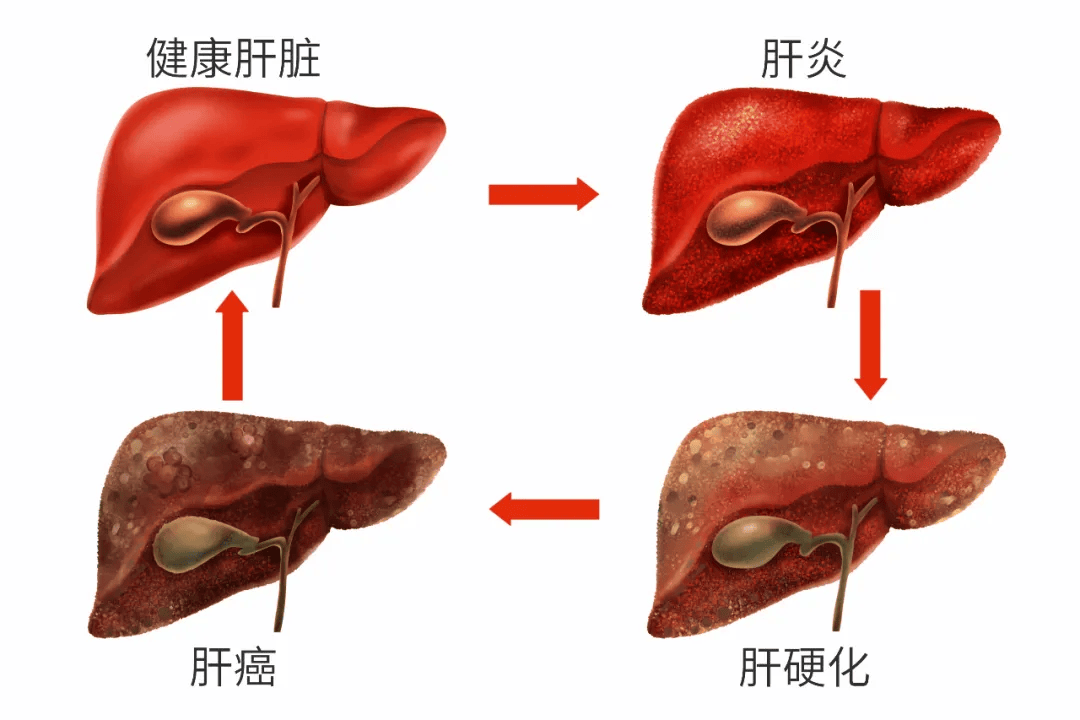 肝源性水肿的特点图片图片