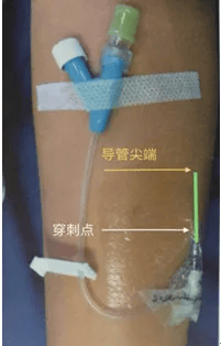 延长管 u 型固定,将肝素帽固定在留置针软管尖端上方,输液结束将封管