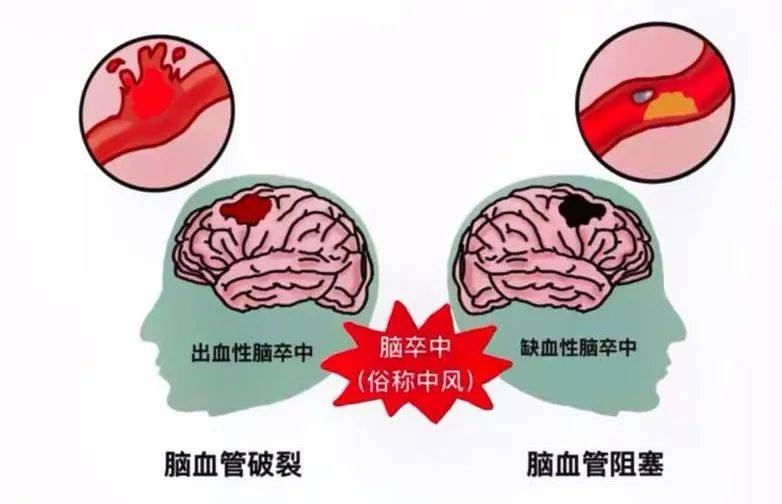 脑血管病