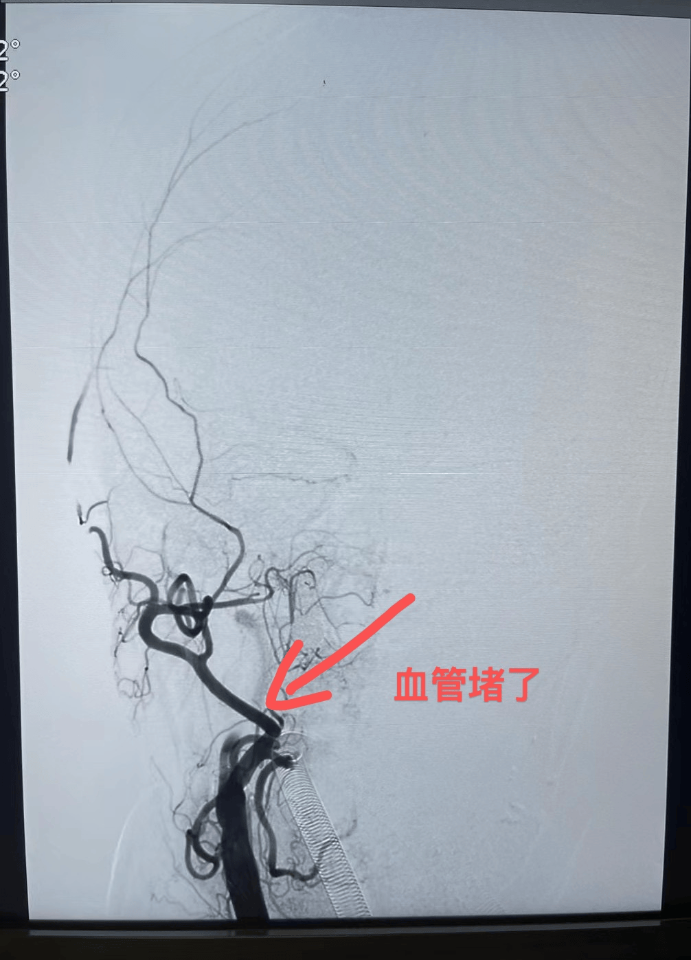 脑梗死的CT图片