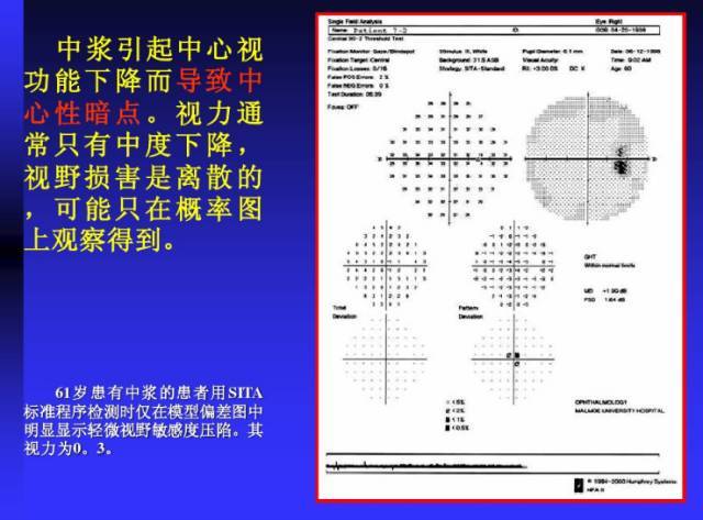 视野检查报告图 解读图片