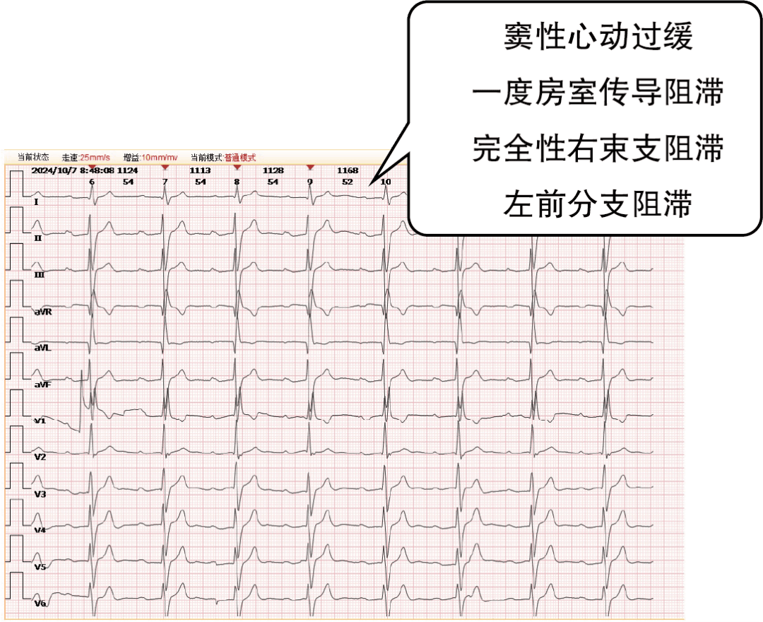 室性停搏心电图图片