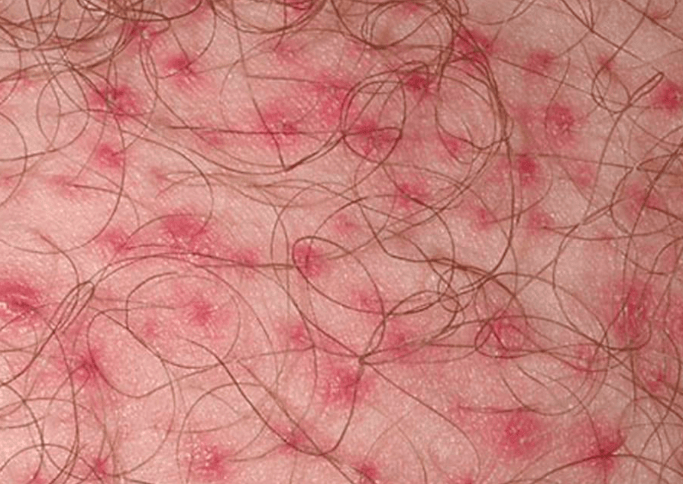 有毛囊的部位都有可能出现毛囊炎,女性私处容易长,男性私处也容易长