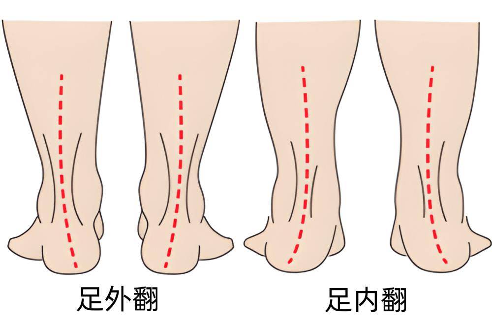 足旋前位图片