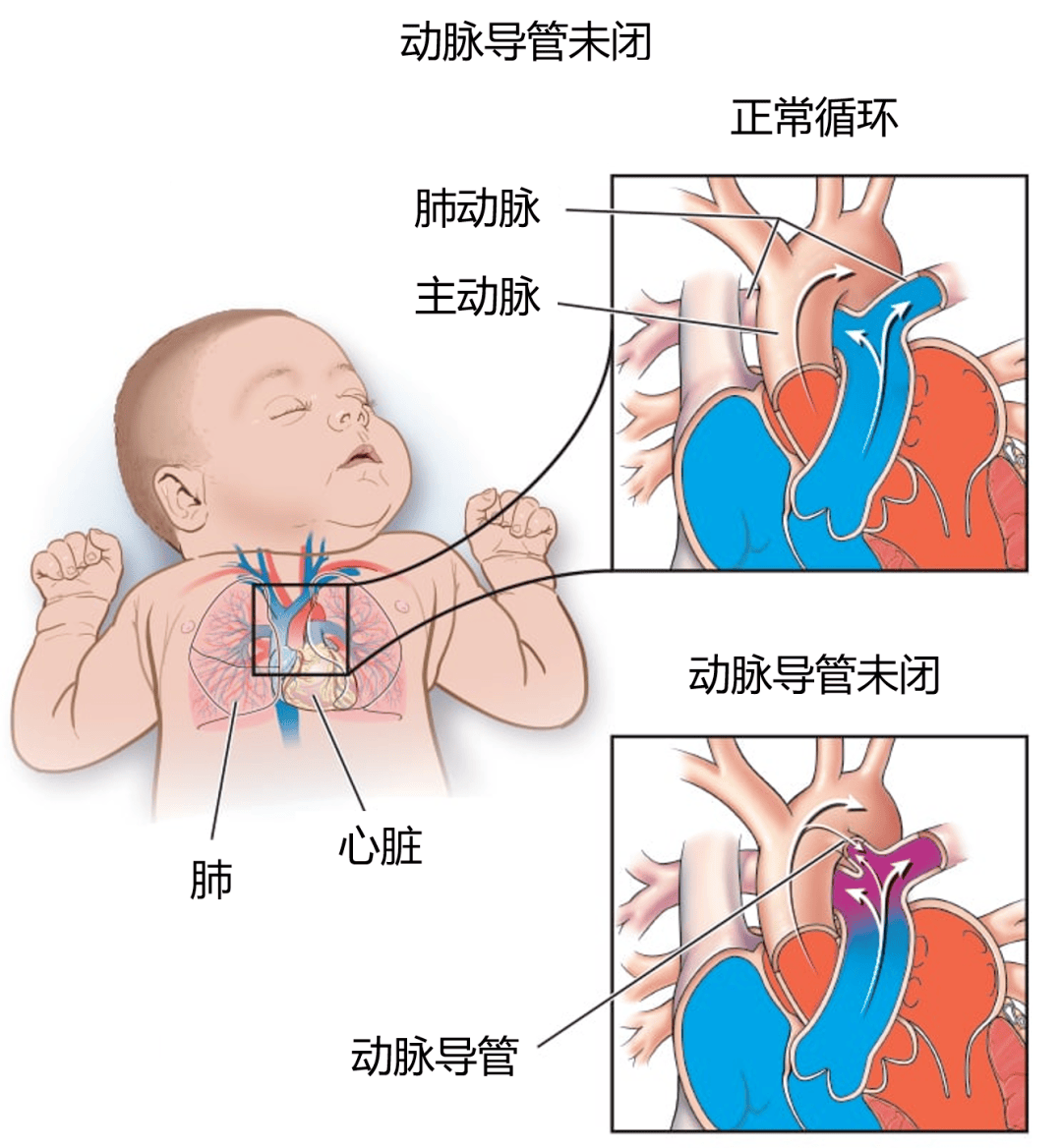 动脉导管未闭手术图片