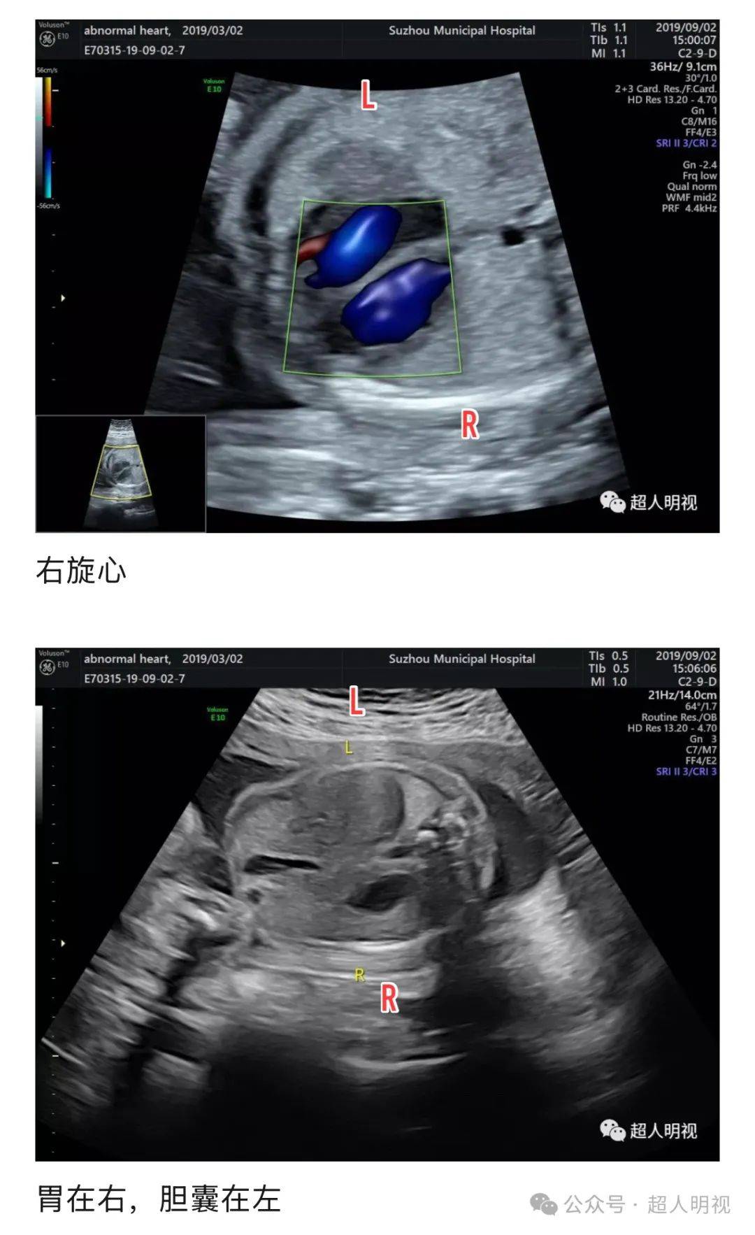 右旋心是指胎儿心轴指向石侧右旋心这个名称只是描述心轴的位置而