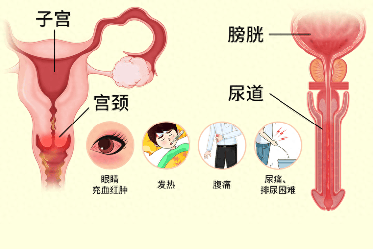 3.非淋菌性尿道炎非淋菌性尿道炎近年来发病率持续攀升。由于很多患者只
