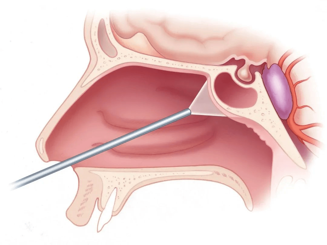 经鼻蝶垂体瘤手术步骤图片