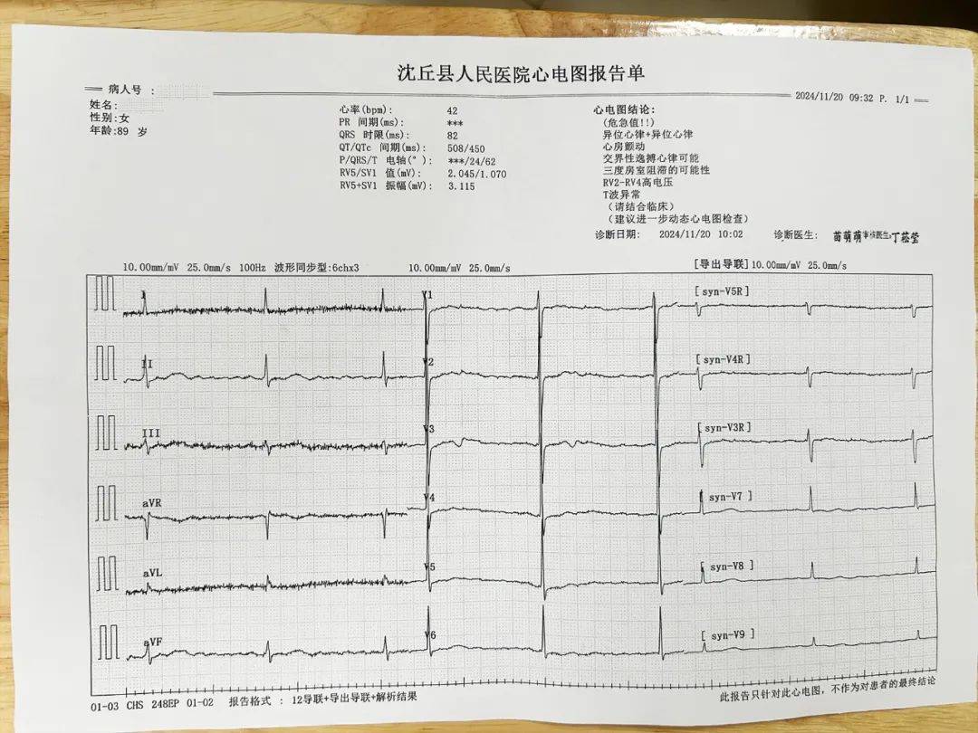 起搏器心律心电图报告图片