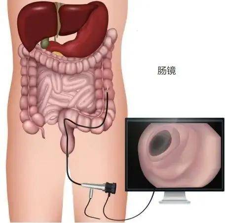 女生做肠镜尴尬图片