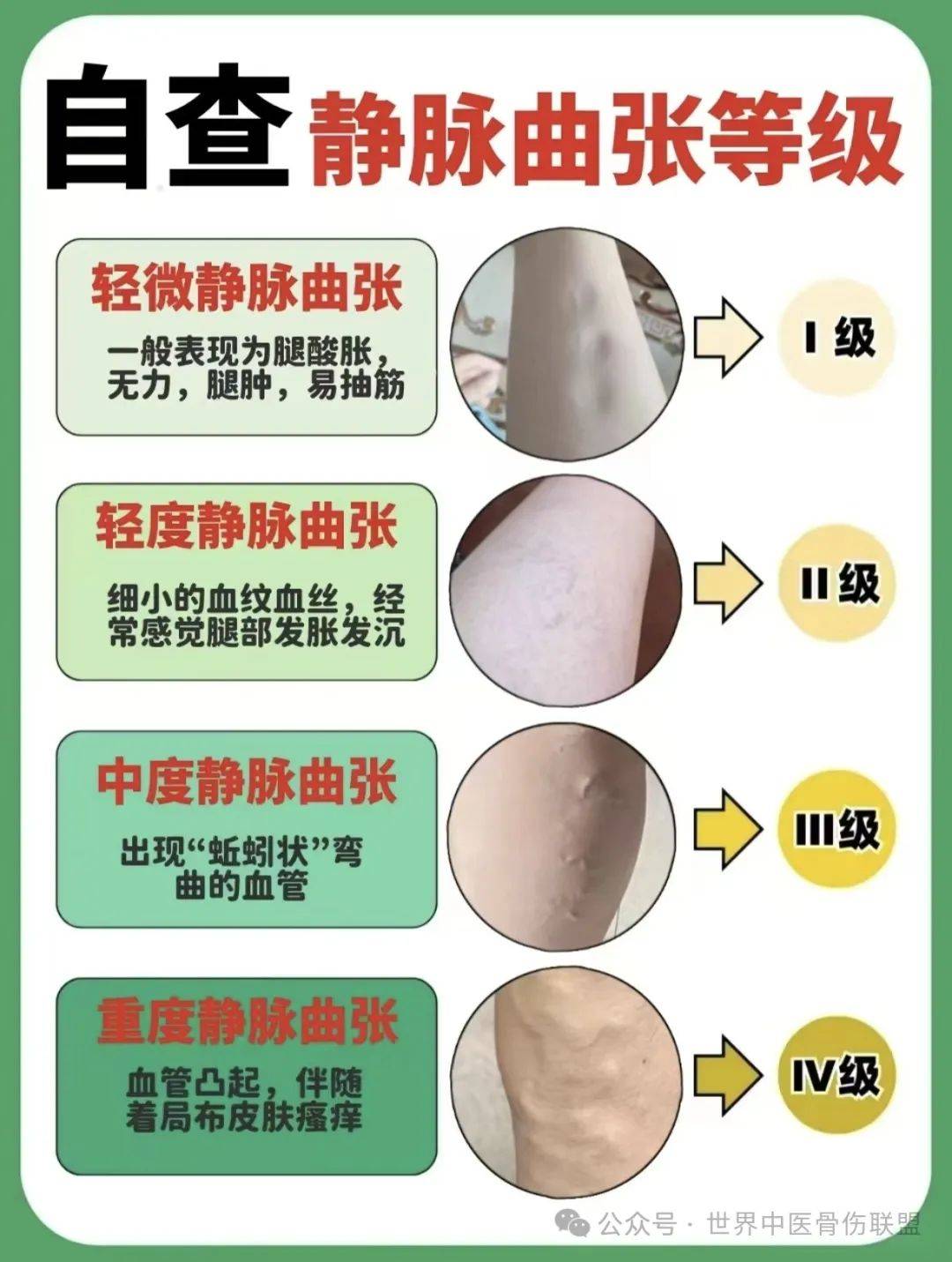 天气越冷,静脉曲张越不可大意!