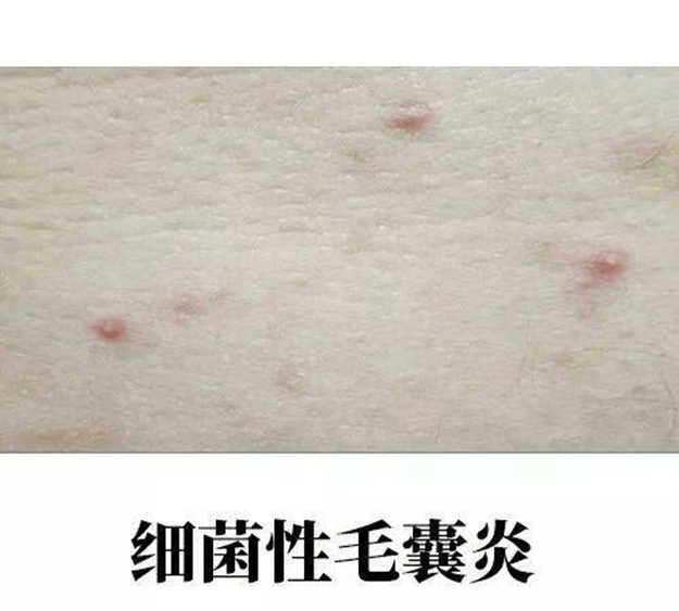 私处红肿,发炎,这些羞于启齿的痘痘大部分都是毛囊炎!
