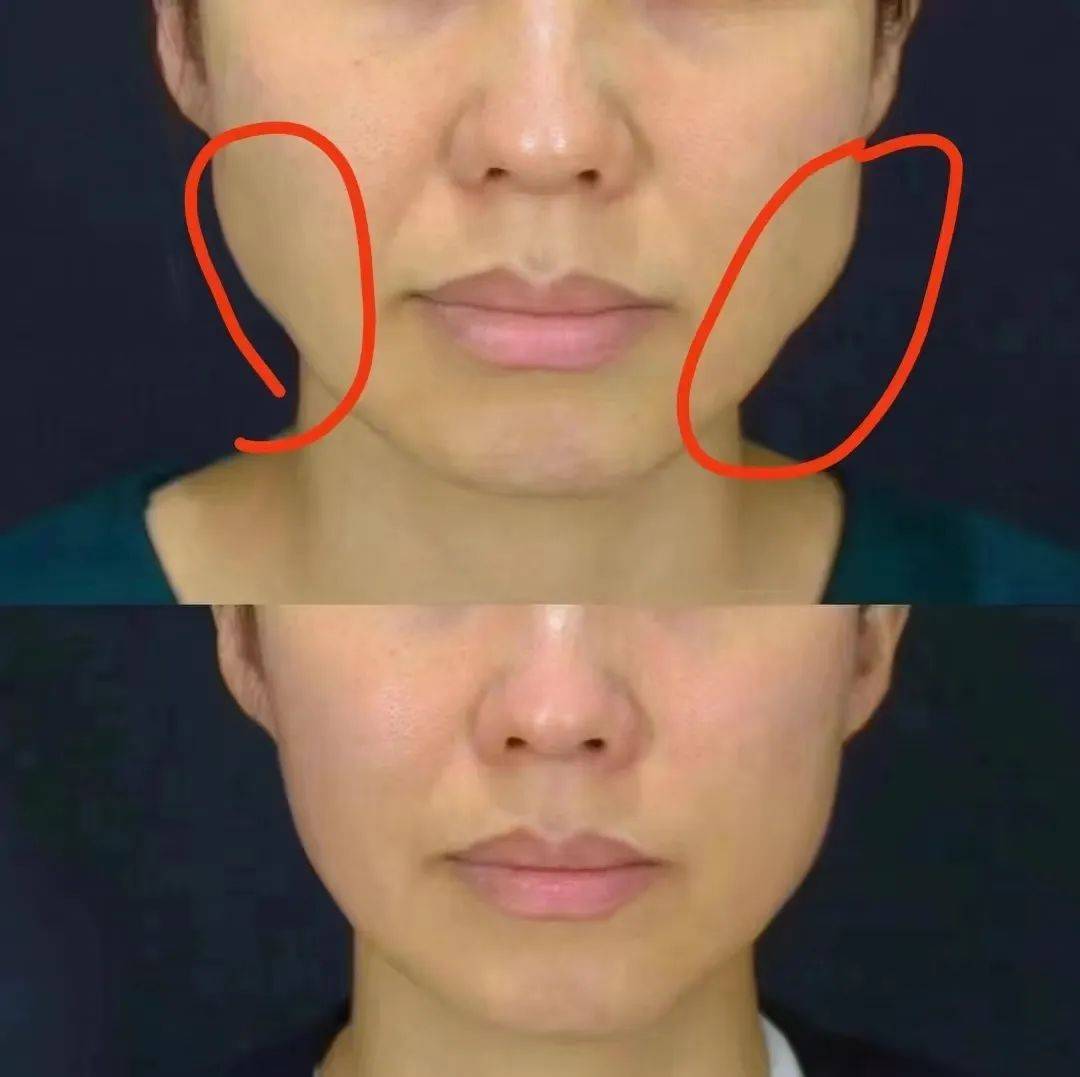 肉毒收紧下颌缘示意图图片