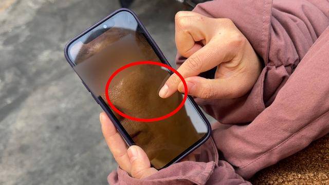 青岛西海岸新区:花际医美18万打除皱针 脸颊凹陷出“大坑”(图3)