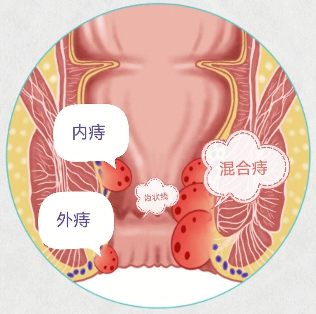 内痔疮 男人图片