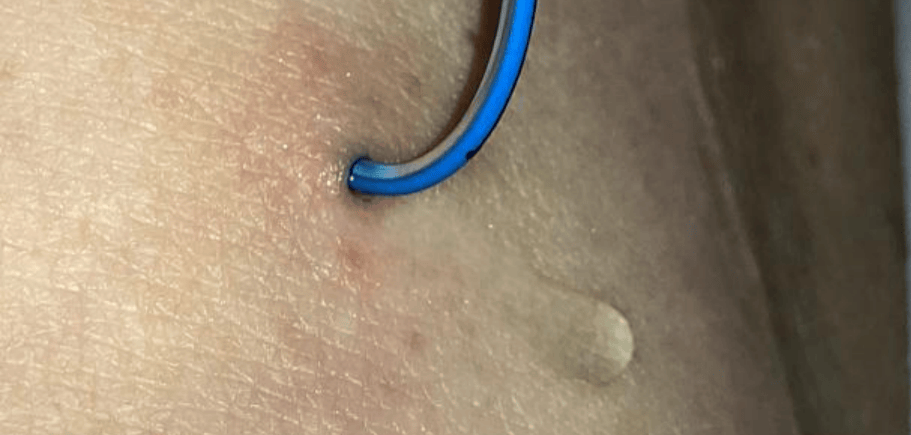 picc 置管术后并发淋巴渗液怎么办?