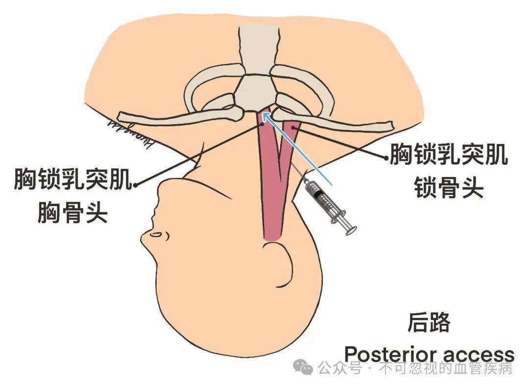 颈内静脉穿刺定位图片