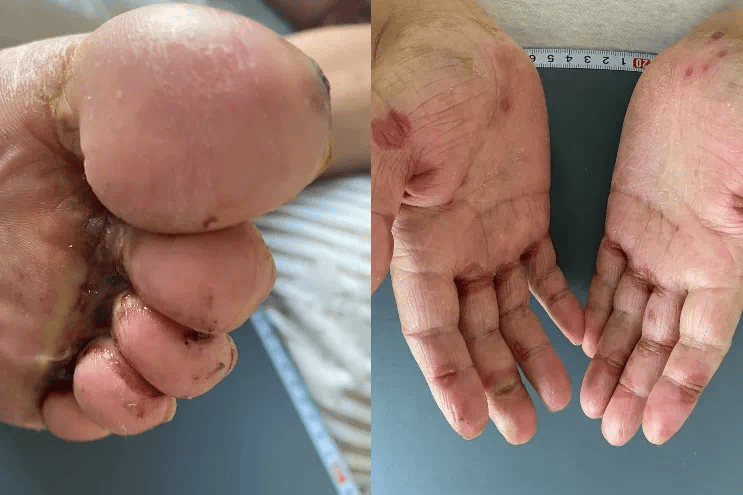 肿瘤用药后导致严重手足皮肤问题患者临床研究招募
