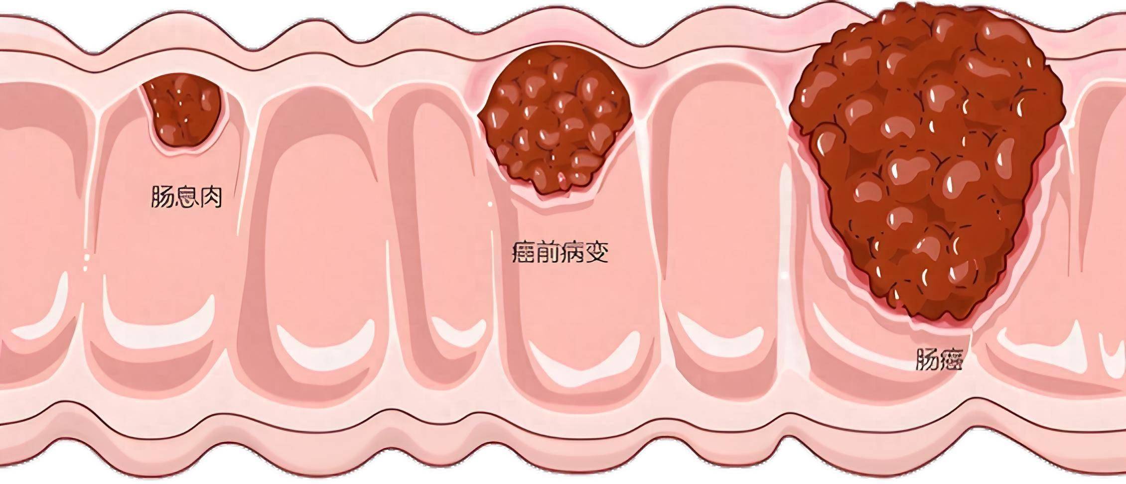 肠镜检查发现管状腺瘤该怎么处理?
