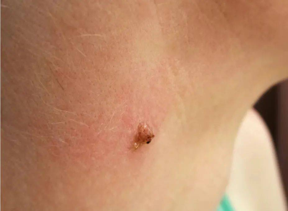  hpv病毒症状图片(hpv病毒症状图片大全)