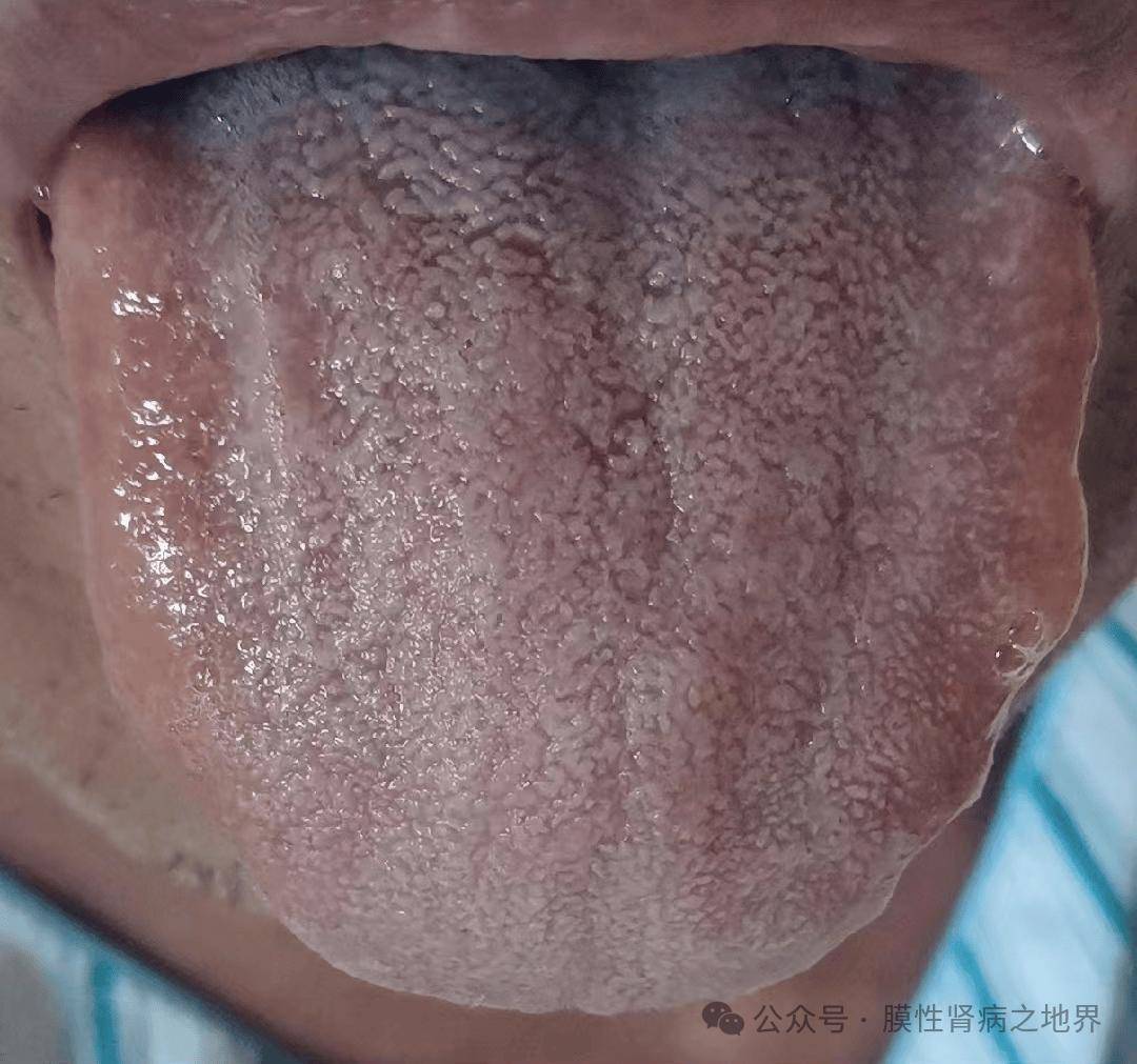 舌苔_饮食_湿气