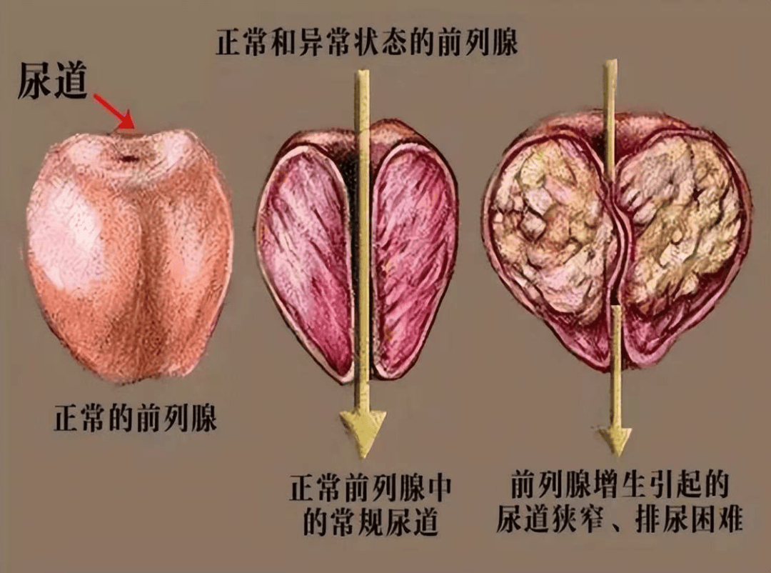 前列腺增生为什么会出现血尿?