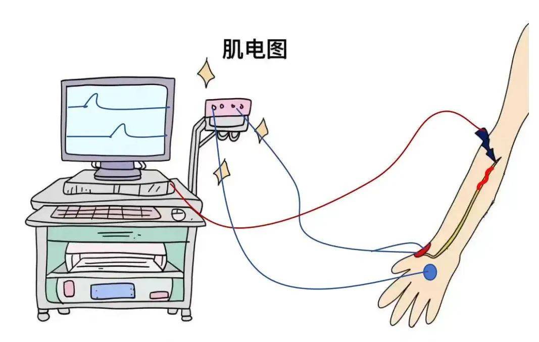 肌电图:打开神经肌肉疾病的"黑箱"