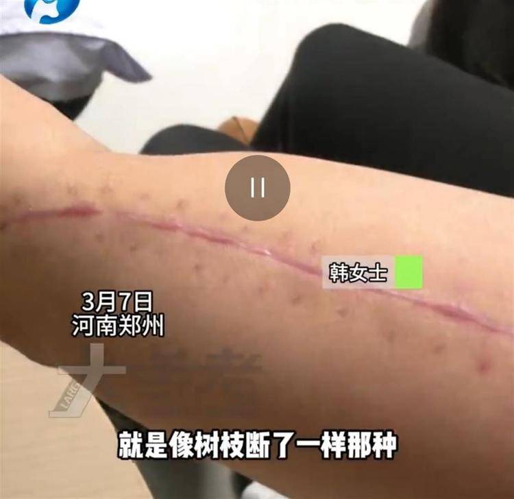 27岁女子参加掰手腕比赛，“咔嚓”一声手臂断了！医生：与对手强弱无关