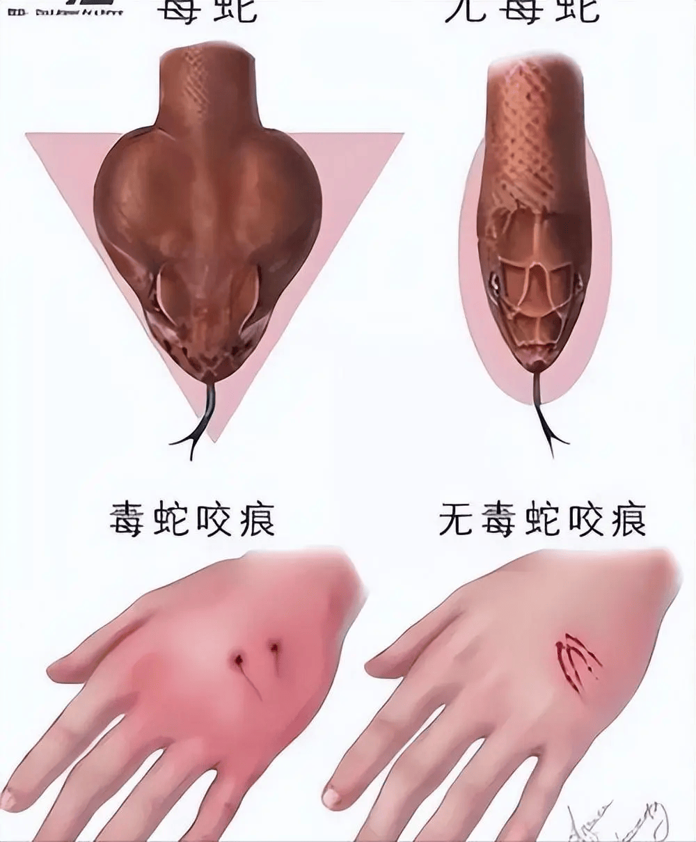 被蛇咬的处理游泳时若突然抽筋,深吸一口气,伸直抽筋腿的膝关节,将