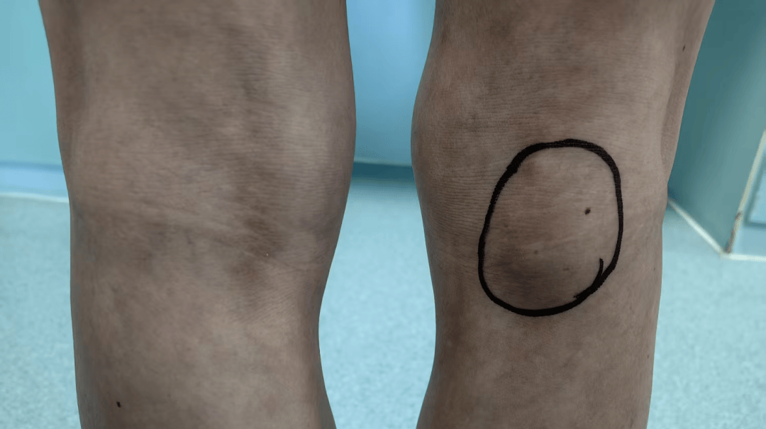 腘窝囊肿不单单是一个囊肿,真正的病因是膝关节内部的退变或半月板