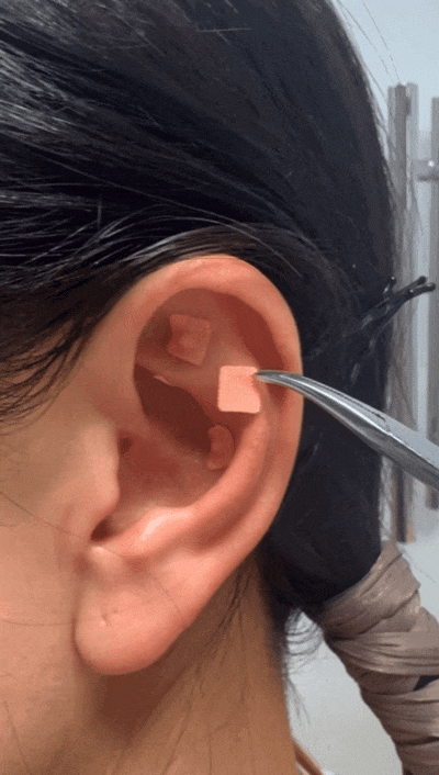 揉耳朵居然就可以通淤堵、活气血?神奇的中医耳穴疗法,快来了解一下~_按摩_穴位_刮痧