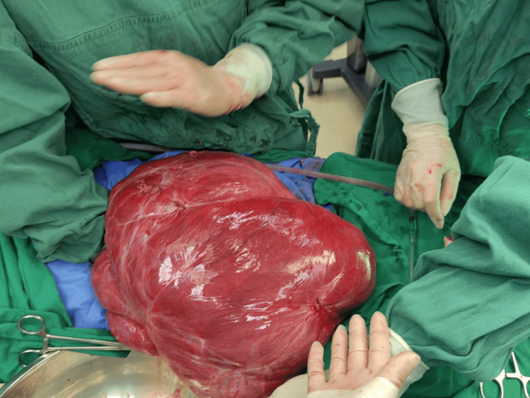 州人民医院妇科二病区成功为一女性患者切除重12.4公斤巨大肿瘤
